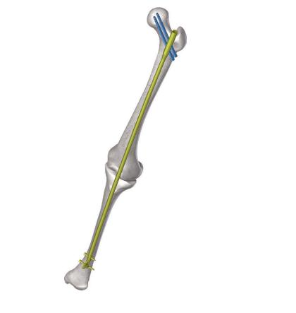 Стержень стегно-великогомілковий інтрамедулярний для артродезу колінного суглоба